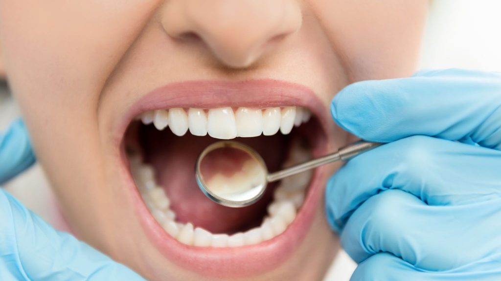 Китайские учёные научились восстанавливать зубную эмаль