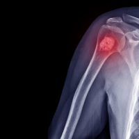 UV-PAM: новый инструмент диагностики и лечения рака костей