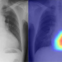 ИИ использует рентген для диагностики заболеваний сердца